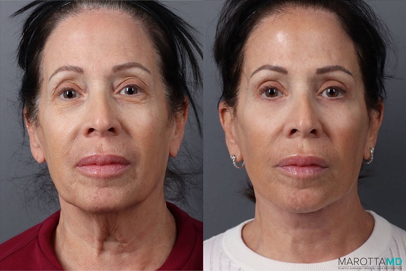 Eyelid Surgery Before & After
