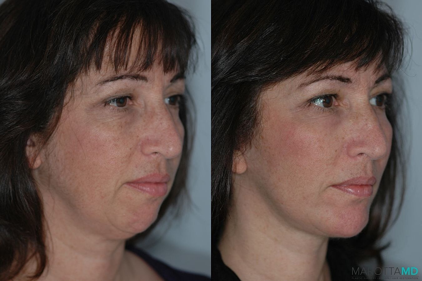 Chin Implant Before & After