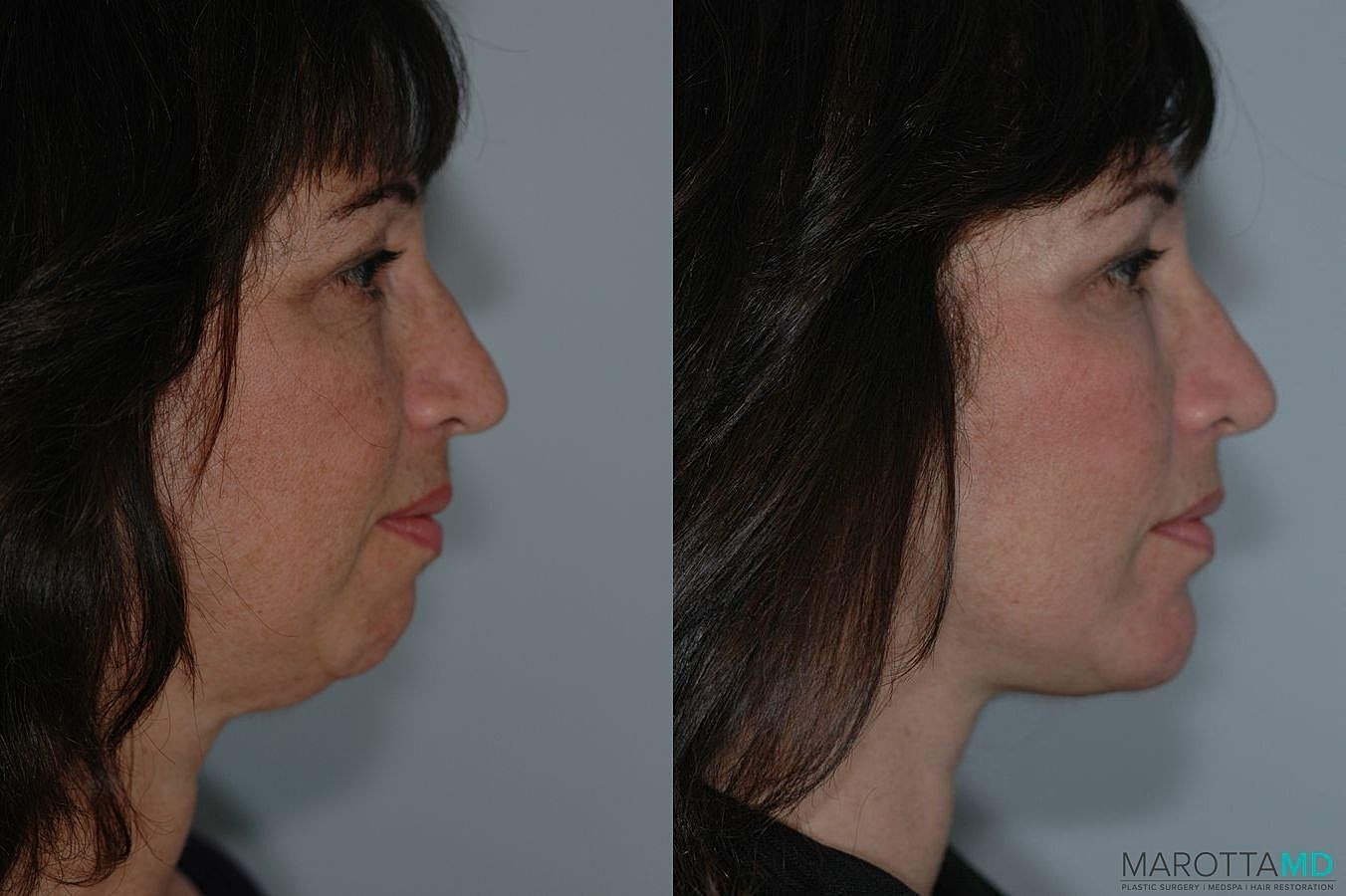 Chin Implant Before & After