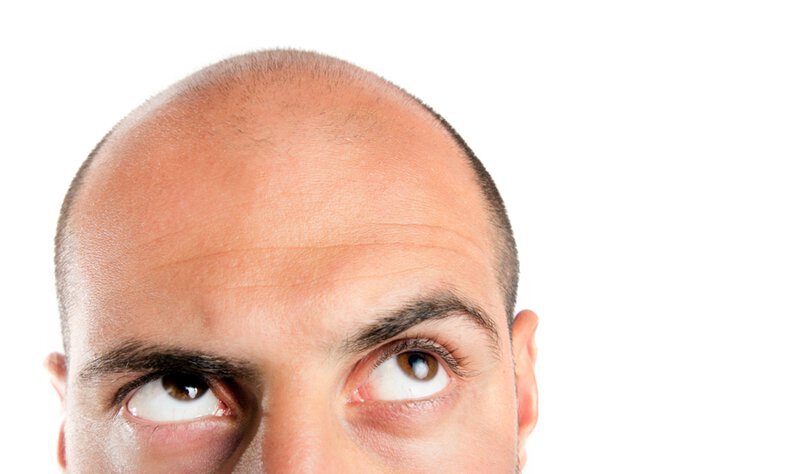 Schedule a hair transplant with Marotta Hair Restoration to restore those once great locks. 