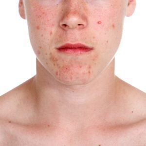 Acne can impact self-confidence as well as happiness.