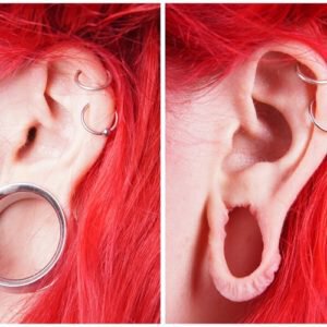 Gauged ears don't have to be a permanent part of your body.