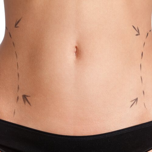 If diet and exercise are not helping you lose that last little bit of weight in problem areas, you may consider liposuction. This surgical procedure could be the answer you are looking for.