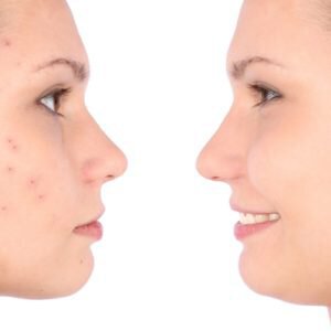 Those with acne scars can schedule scar revision treatments to repair damaged areas of the skin.