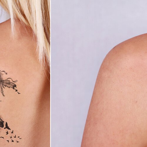 What to expect from your first tattoo removal