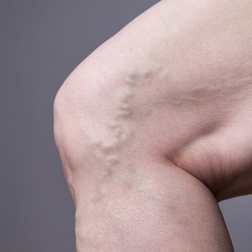 Vanquish spider veins with radio frequency venous ablation