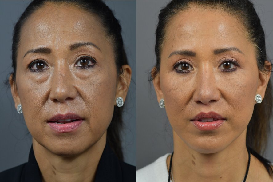Long Island Plastic Surgery before and after