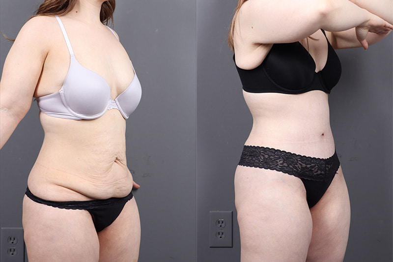 Tummy Tuck Before & After Image