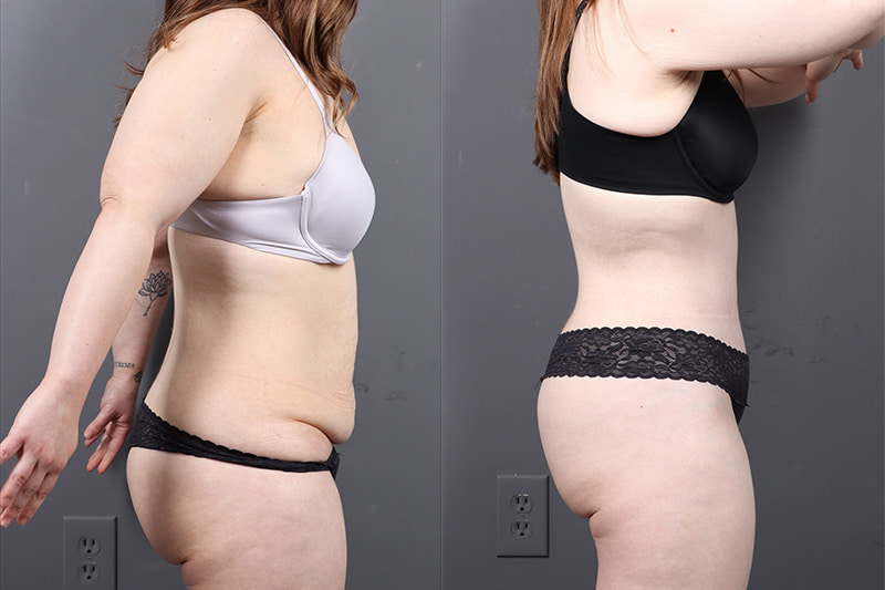 Tummy Tuck Before & After Image