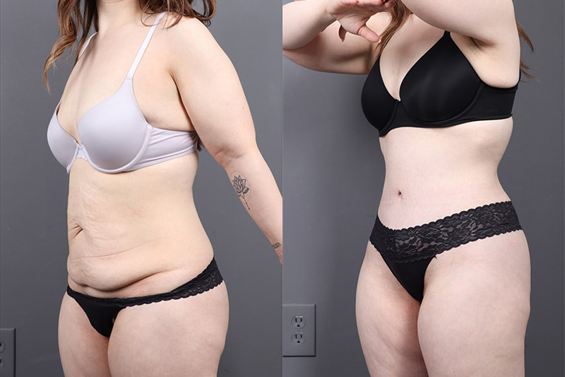 Tummy Tuck Before & After Image