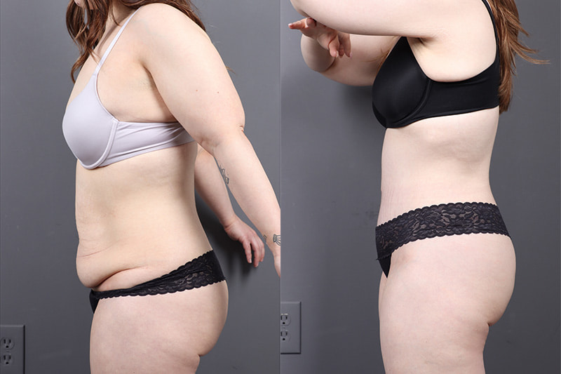 Tummy Tuck Before & After Image