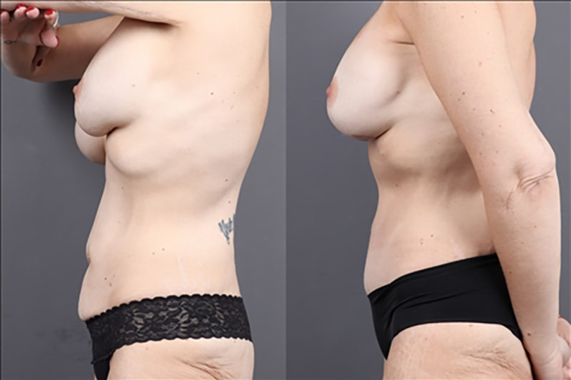 Tummy Tuck Before & After Image