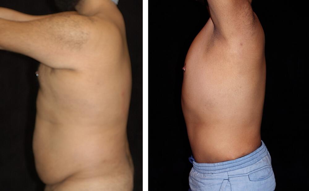 Body Contouring Before & After Image