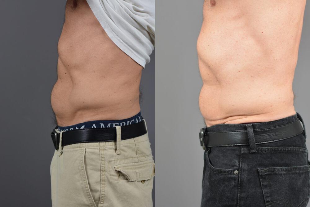Body Contouring Before & After Image
