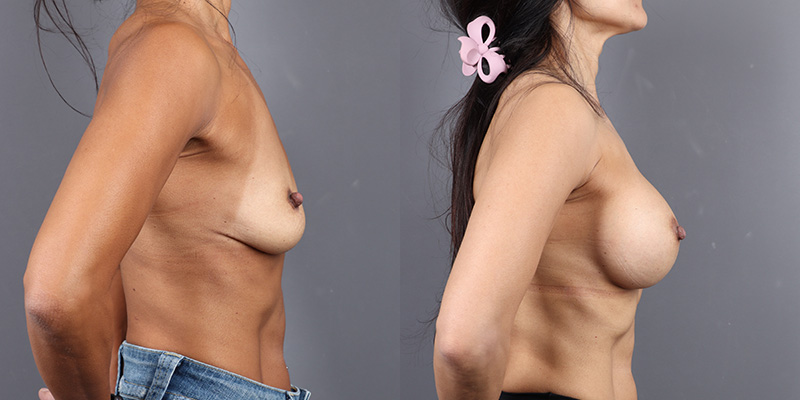 Breast Augmentation Before & After Image