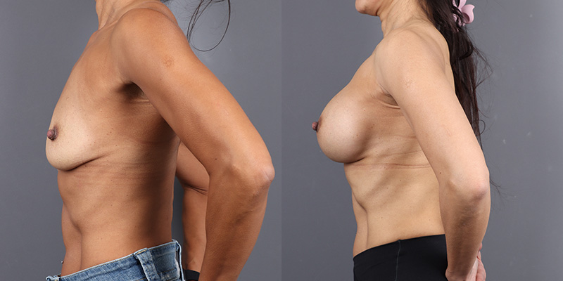 Breast Augmentation Before & After Image