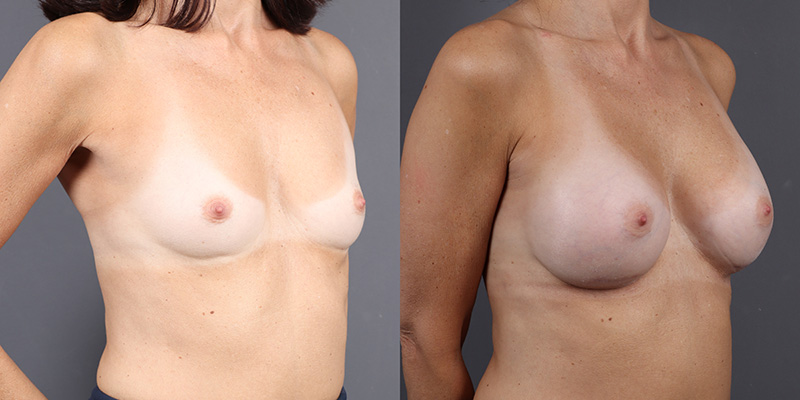 Breast Augmentation Before & After Image