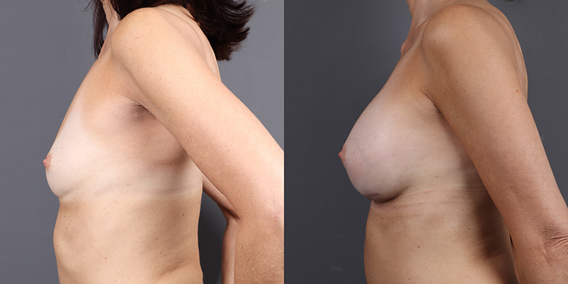 Breast Augmentation Before & After Image