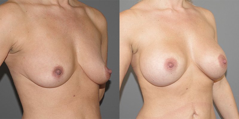 Breast Augmentation Before & After Image