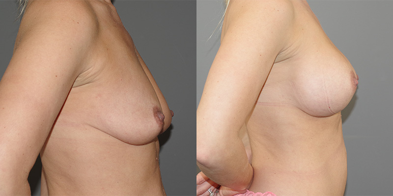 Breast Augmentation Before & After Image