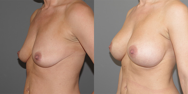 Breast Augmentation Before & After Image