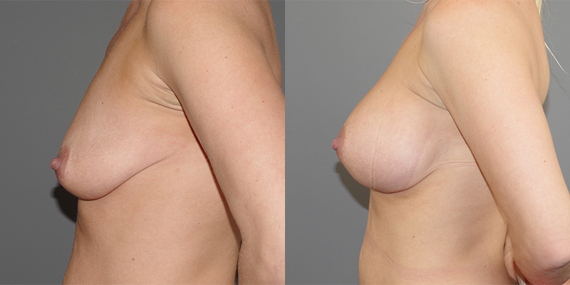 Breast Augmentation Before & After Image