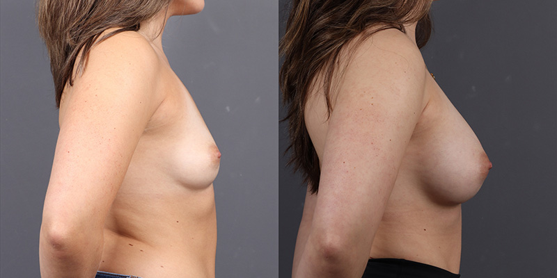 Breast Augmentation Before & After Image