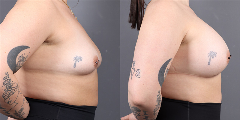 Breast Augmentation Before & After Image