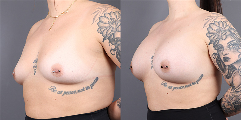 Breast Augmentation Before & After Image