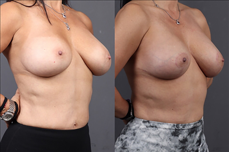 Breast Lift Before & After Image