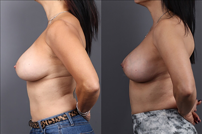 Breast Lift Before & After Image