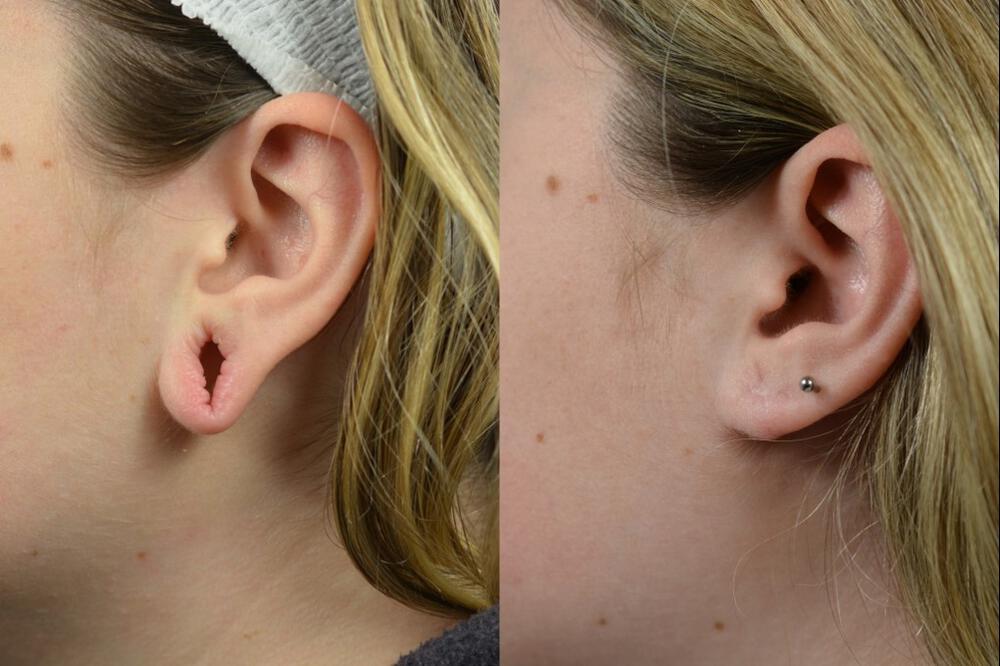 Ear Surgery Before & After Image