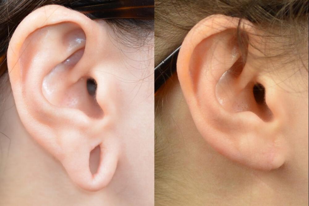 Ear Surgery Before & After Image