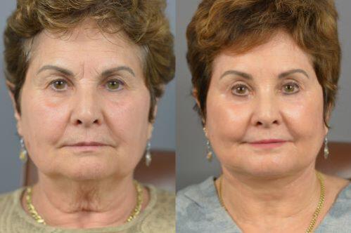 Endoscopic Brow Before & After Image