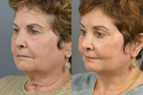 Endoscopic Brow Before & After Image