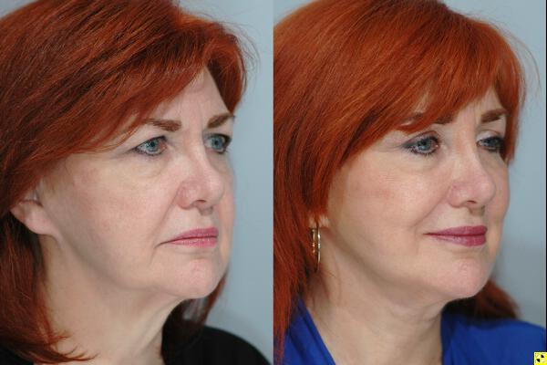 Facelift Before & After Image