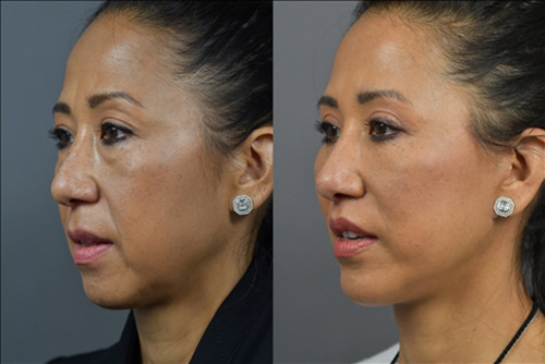 Facelift Before & After Image