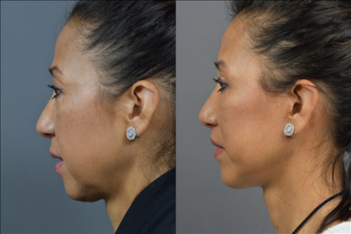 Facelift Before & After Image