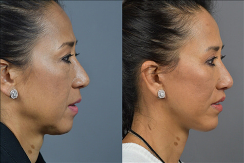 Facelift Before & After Image