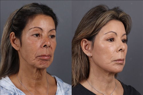 Facelift Before & After Image