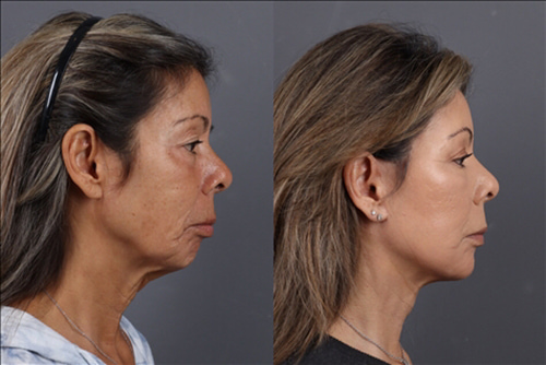 Facelift Before & After Image