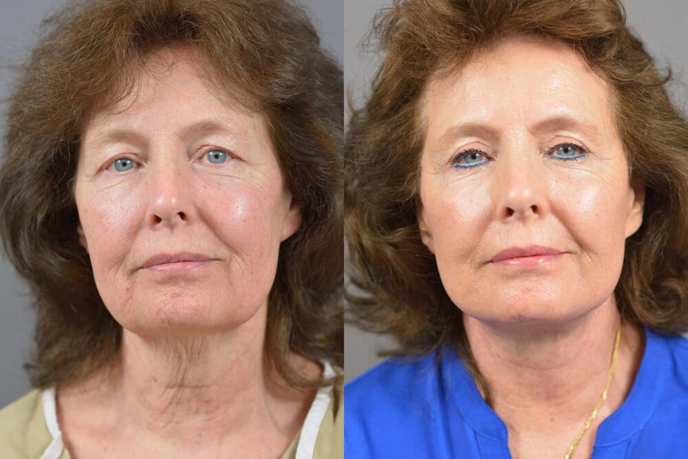 Facial Rejuvenation Before & After Image