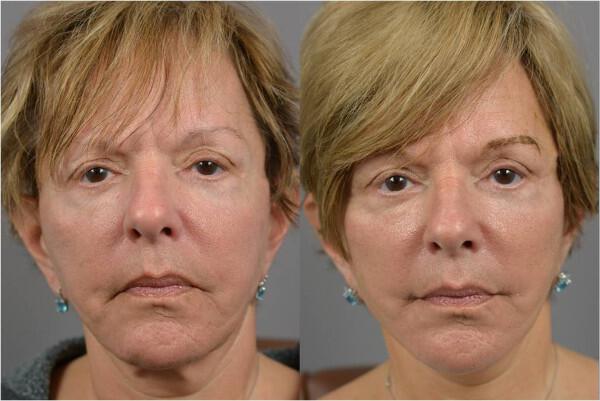 Grin Lift Before & After Image