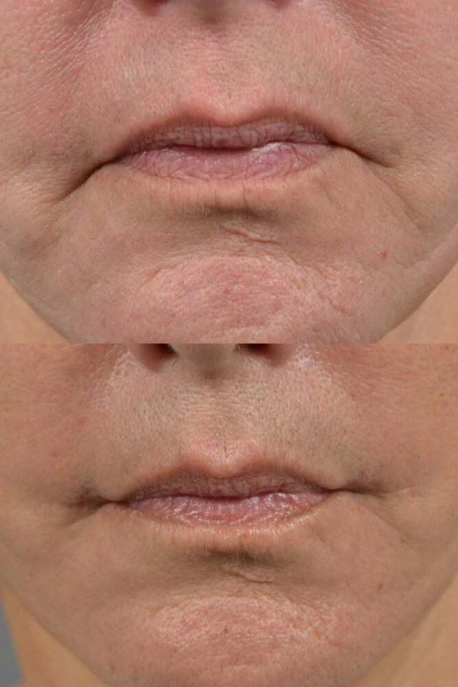 Grin Lift Before & After Image