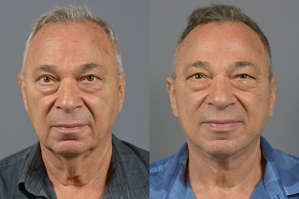 Male Facelift Before & After Image