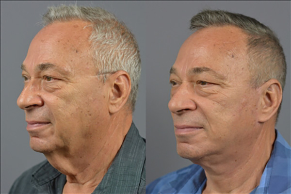 Male Facelift Before & After Image