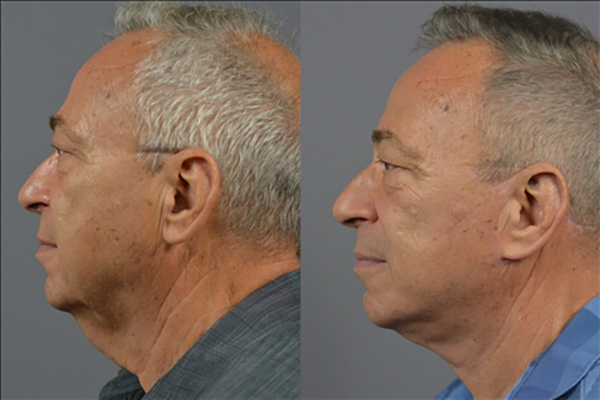 Male Facelift Before & After Image