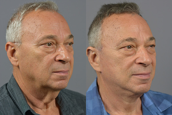 Male Facelift Before & After Image