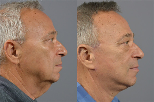 Male Facelift Before & After Image