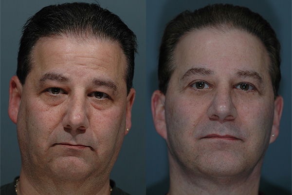 Male Facial Rejuvenation Before & After Image